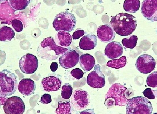 实例证明：脐带干细胞联合造血干细胞治疗儿童白血病更有效