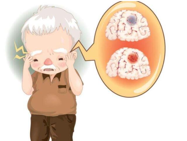 脐带干细胞治疗脑卒中，帮助卒中病人恢复健康