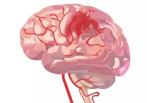 脐带干细胞治疗脑卒中，帮助卒中病人恢复健康