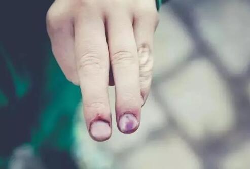 案例集锦:脐带间充质干细胞临床治疗疾病案例 案例集锦:脐带间充质干细胞临床治疗疾病案例