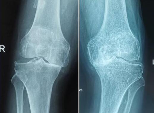 脐带间充质干细胞治疗膝关节软骨磨损效果显著