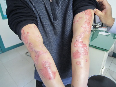 银屑病迎来脐带间充质干细胞新疗法